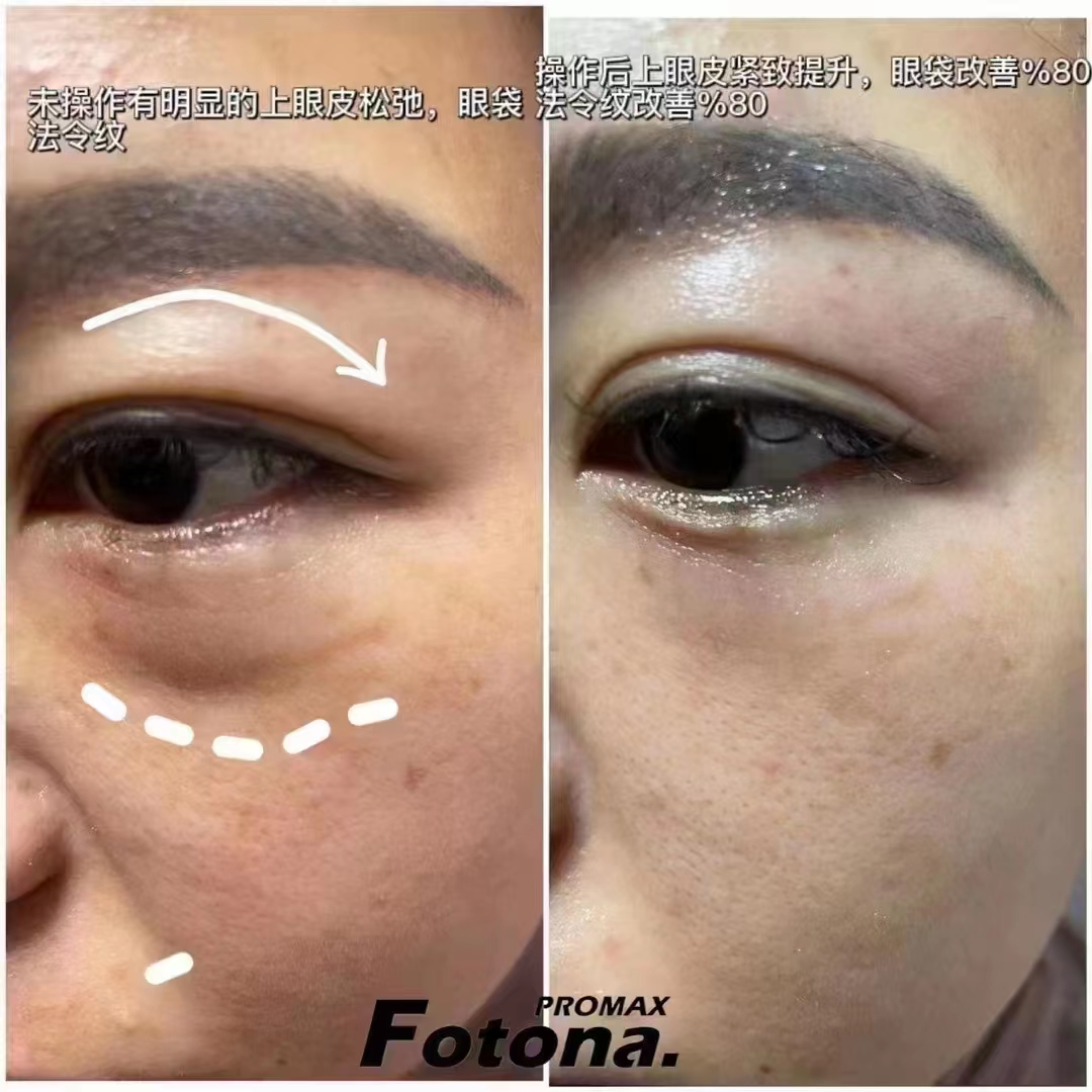 优仙国际眼部抗衰项目，体验一次效果立竿见影